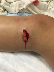 Exit wound. Monday Am. 